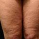 photo de la cellulite